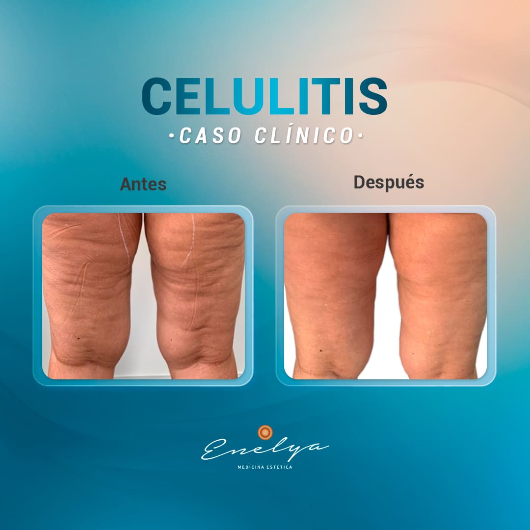Celulitis-enelyaperu