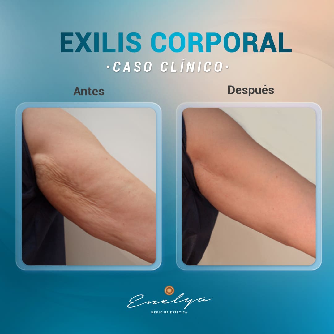 EXILIS-CORPORAL-enelyaperu