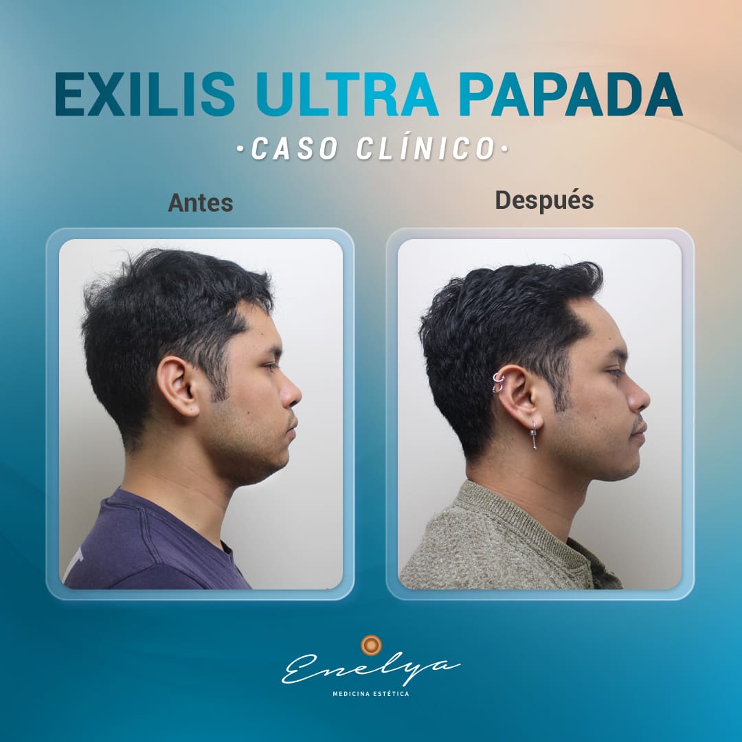 EXILIS-ULTRA -PAPADA-enelyaperu