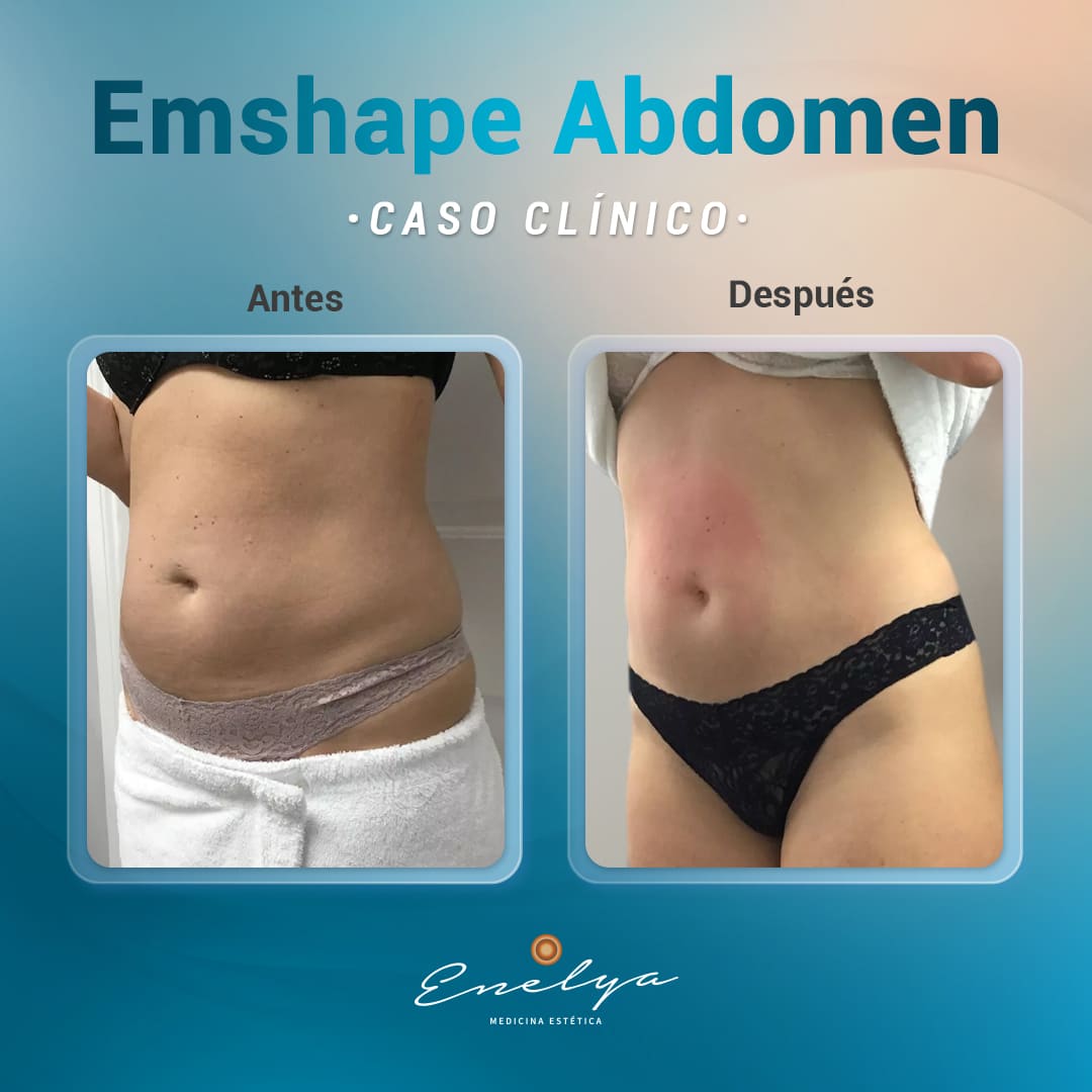 Emshape Abdomen