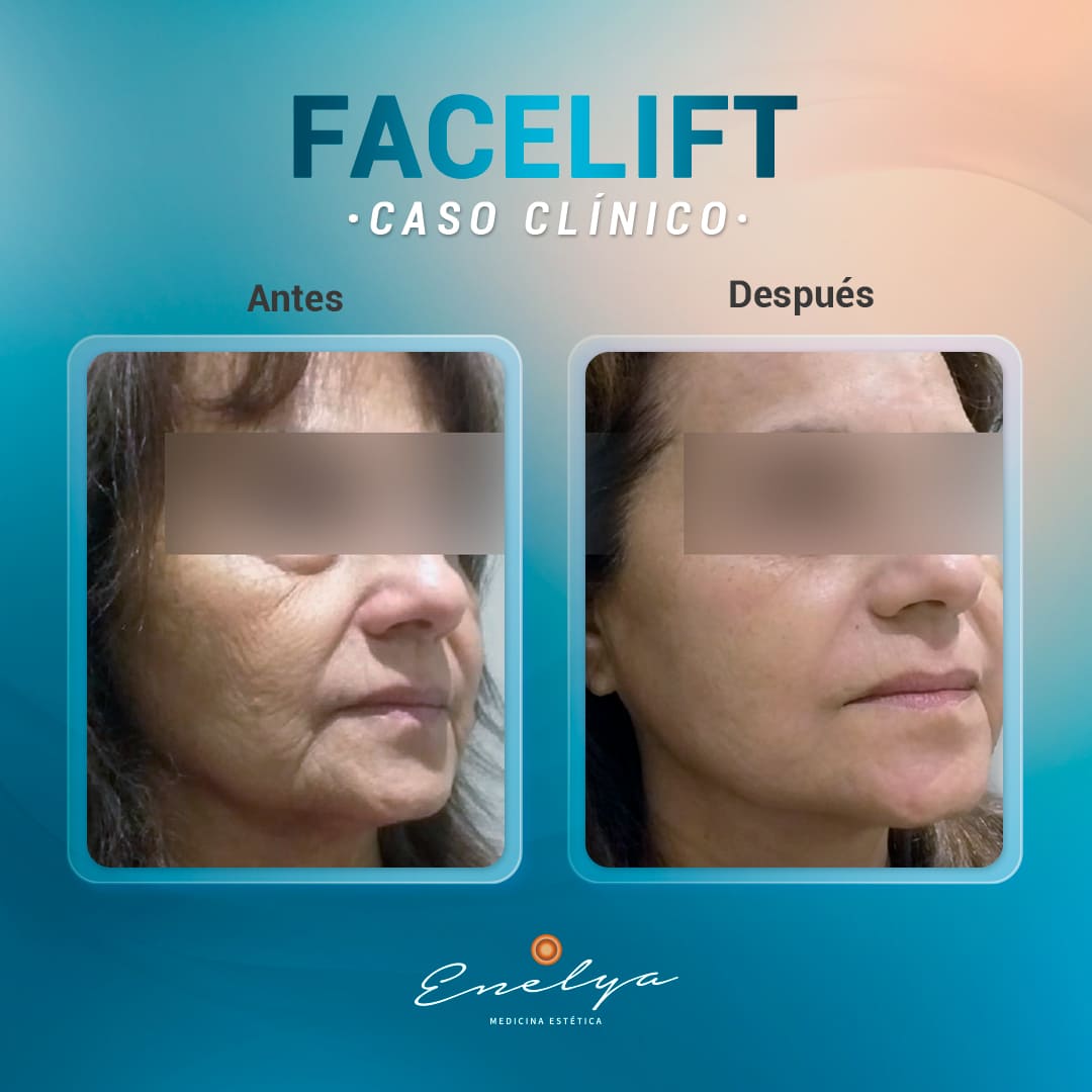 Facelift-1-enelyaperu