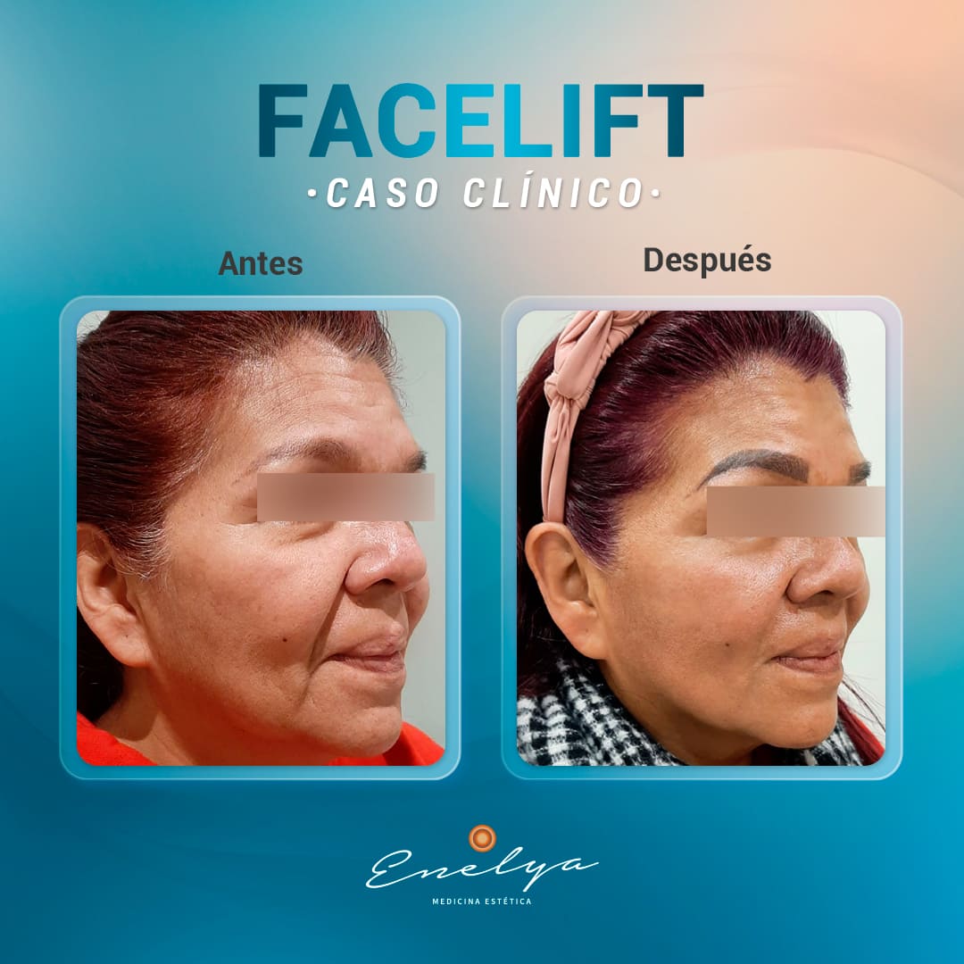 Facelift-2-enelyaperu