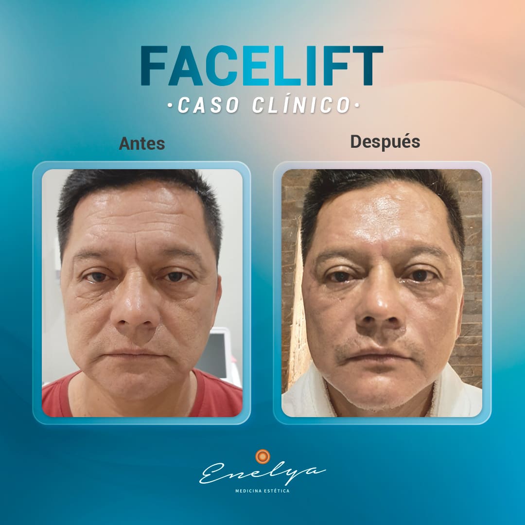 Facelift-HOMBRE-enelyaperu