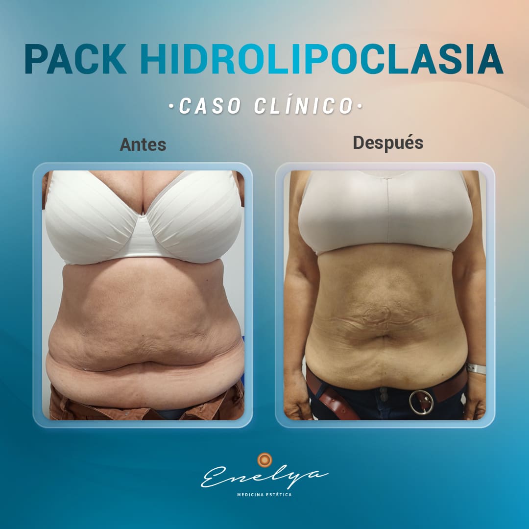 Hidrolipoclasia-enelyaperu