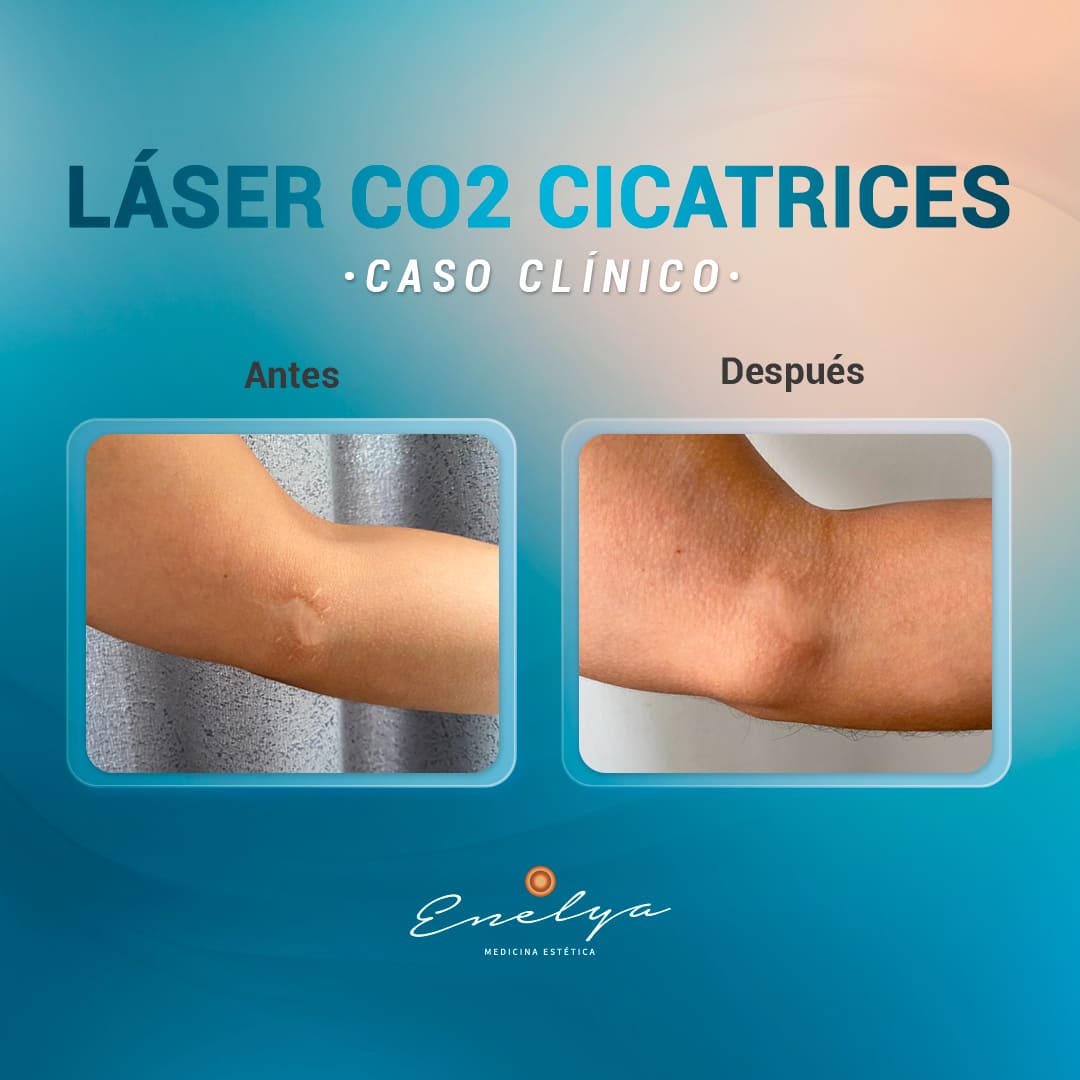 LÁSER-CICATRICES-Enelya