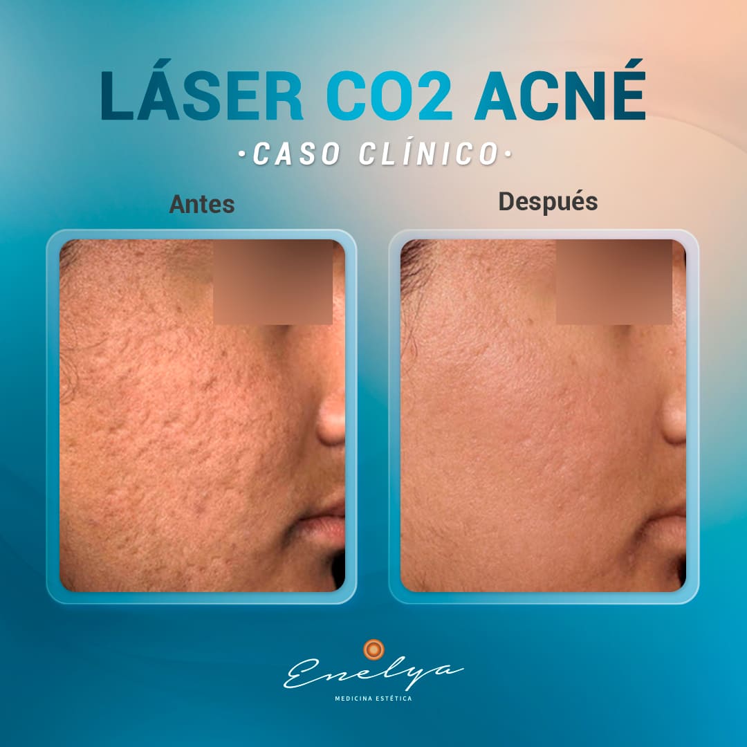 Láser-CO2-Acné-Enelya