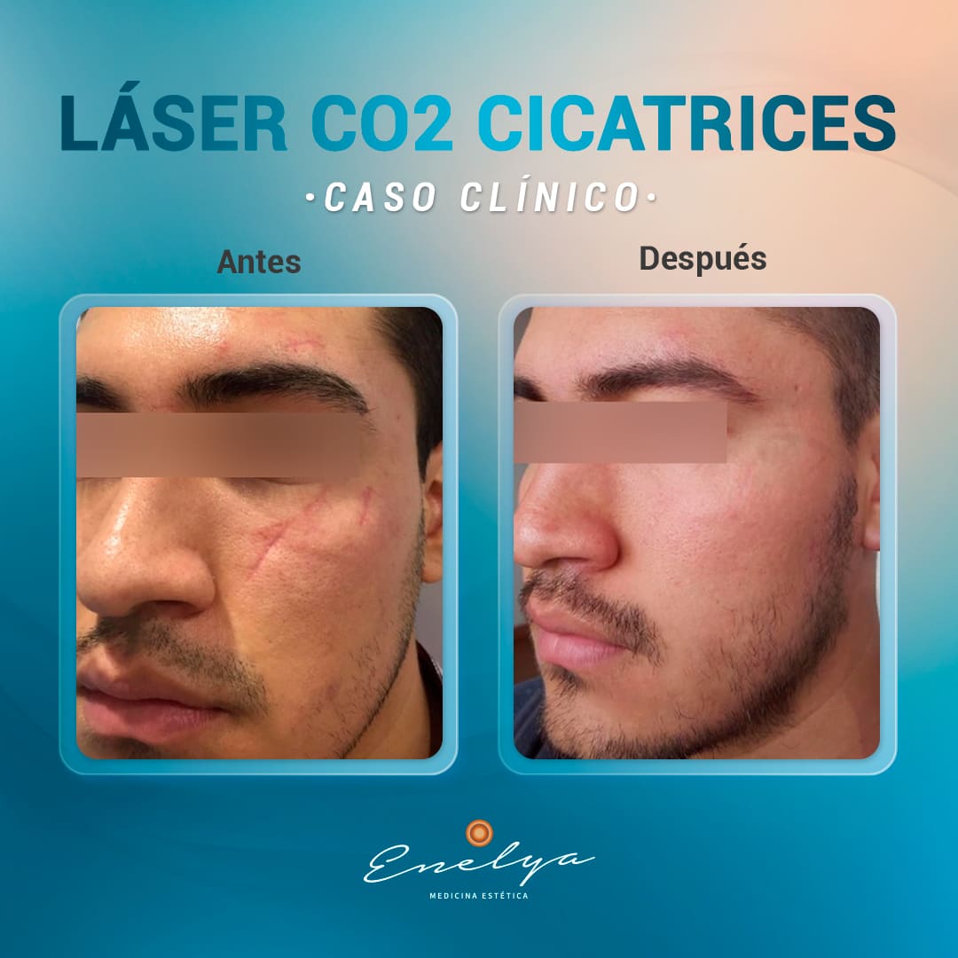 Láser-CO2-Cicatrices-Enelya