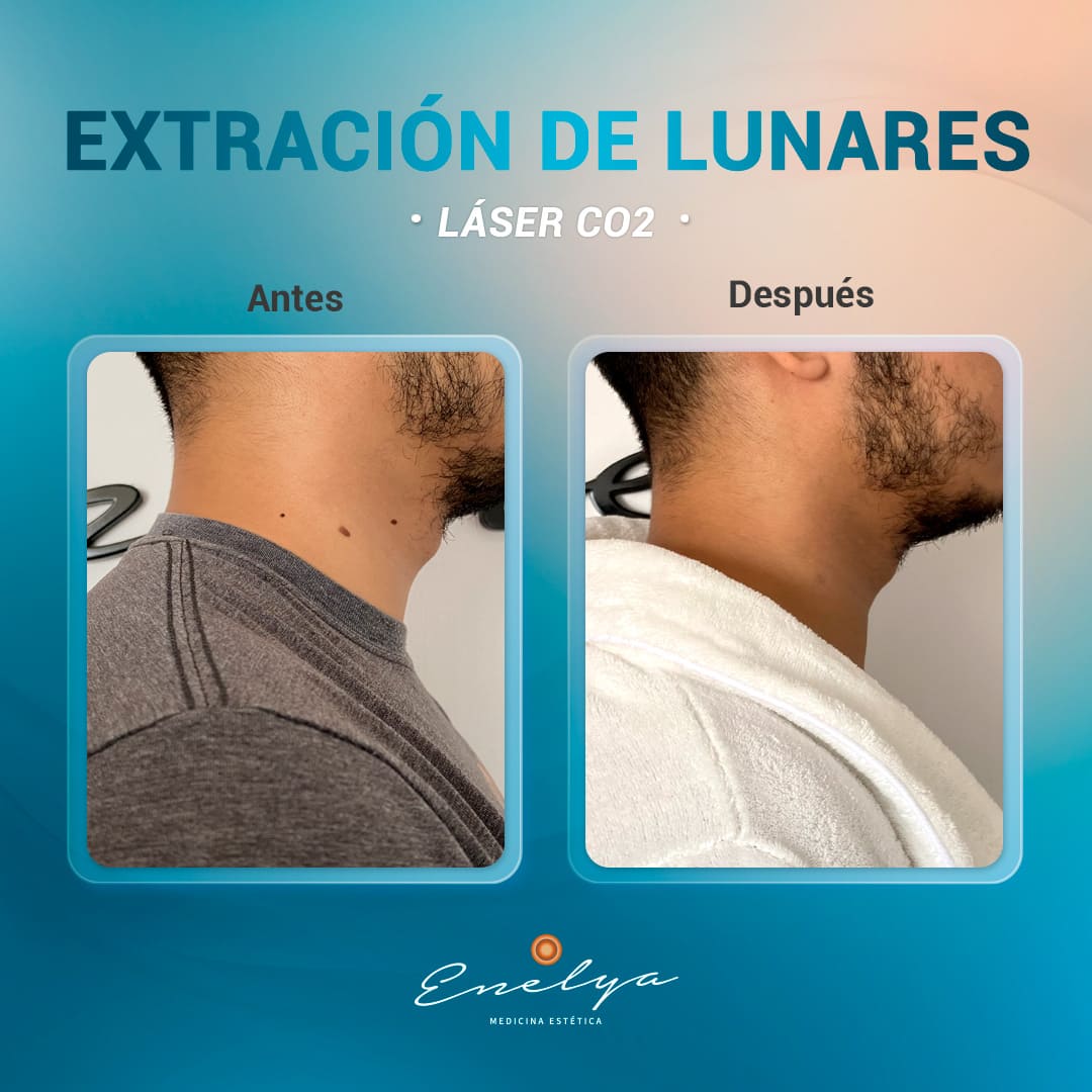 Lunares-antes-después-Enelya