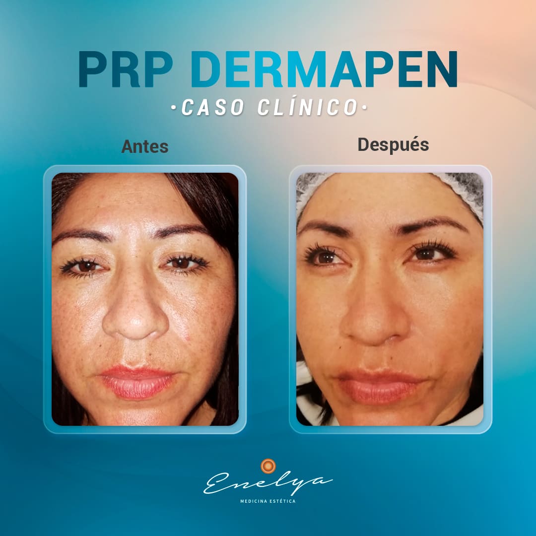 PRP-Dermapen-enelyaperu
