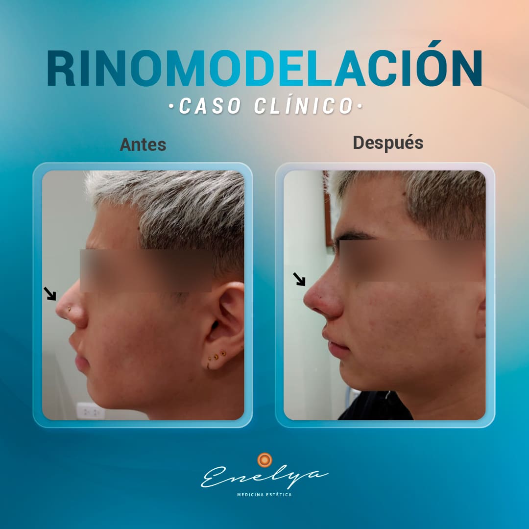 Rinomodelación-enelyaperu