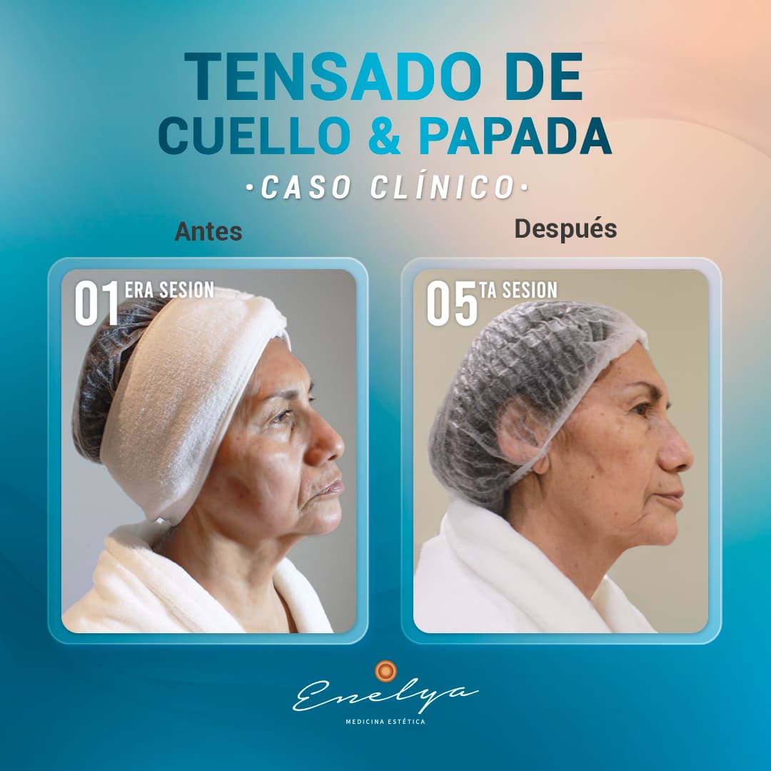 Tensado-Cuello-Papada-1-enelyaperu