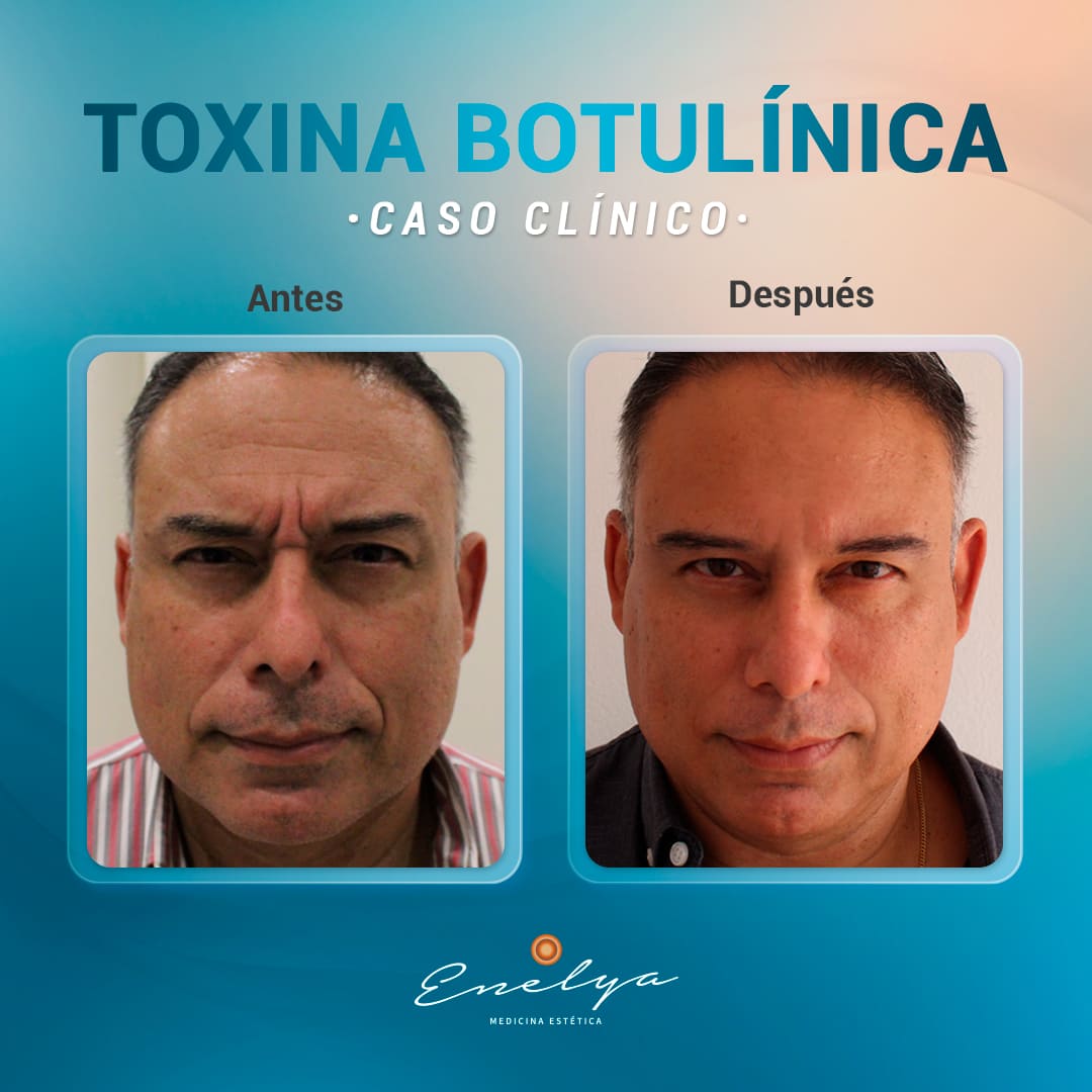 Toxina-Botulinica-enelyaperu